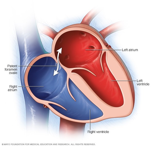 PFO - Image: MAYO Foundation